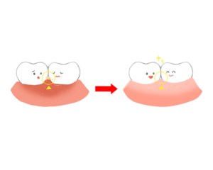 歯間ブラシで汚れが取れて歯ぐきが引き締まる前後のイラスト