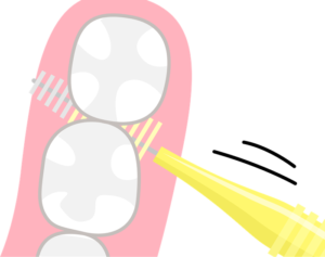 歯間ブラシを歯の隙間に正しく挿入するイラスト