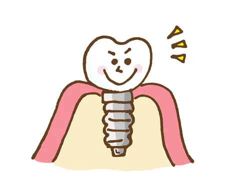 あごの骨に埋め込まれたインプラントのイラスト