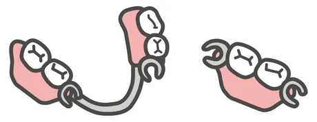 金属のバネで固定する部分入れ歯のイラスト