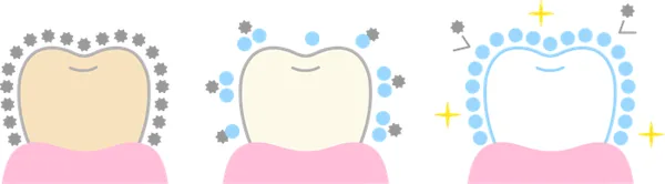 歯の着色汚れが落ちて白くなる過程のイラスト