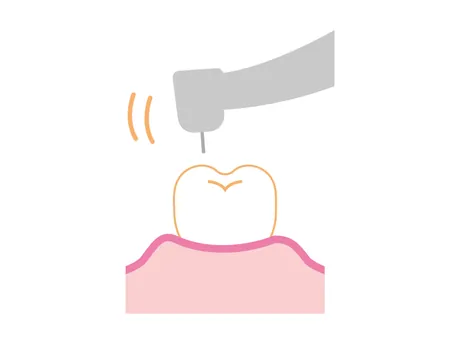 歯を削る治療のイラスト